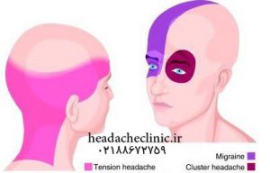سردرد شما چه نوع سردردی است و چگونه درمان می شود؟